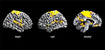 MRI images of the brain with yellow highlights showing areas of conectivity