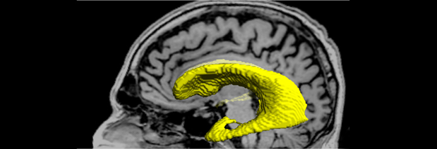 Image of brain ventricles